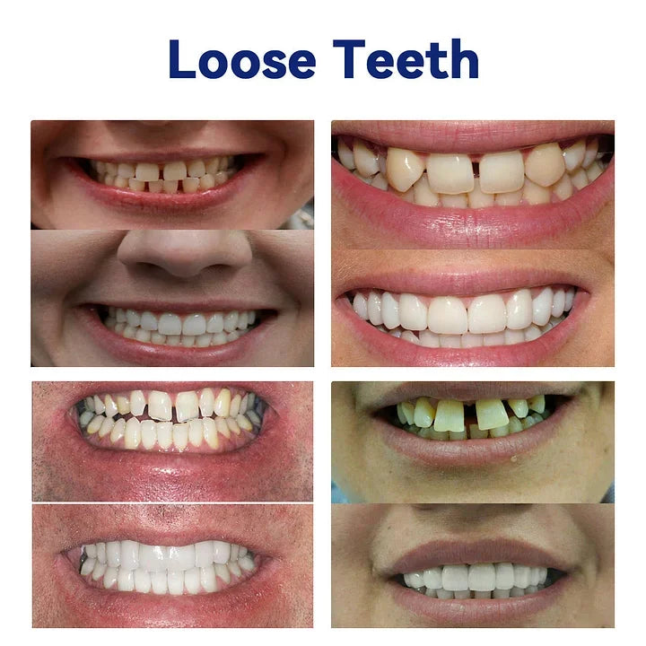HermsaĀ®-š¦·Advanced Customized Full Denture Set𦷠(ā°Limited time discount last 30 minutesā°)