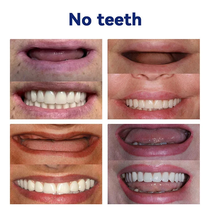 HermsaĀ®-š¦·Advanced Customized Full Denture Set𦷠(ā°Limited time discount last 30 minutesā°)
